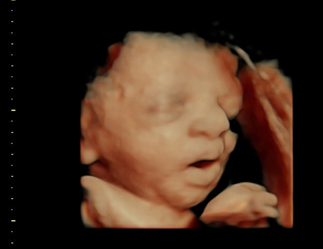 3D ultrasound image at 31 weeks